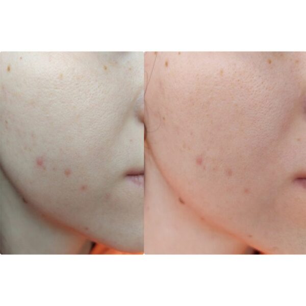 سرم ضد لک و جوش اکسیس وای AXIS Y Spot The Difference Blemish Treatment 3 700x700 1